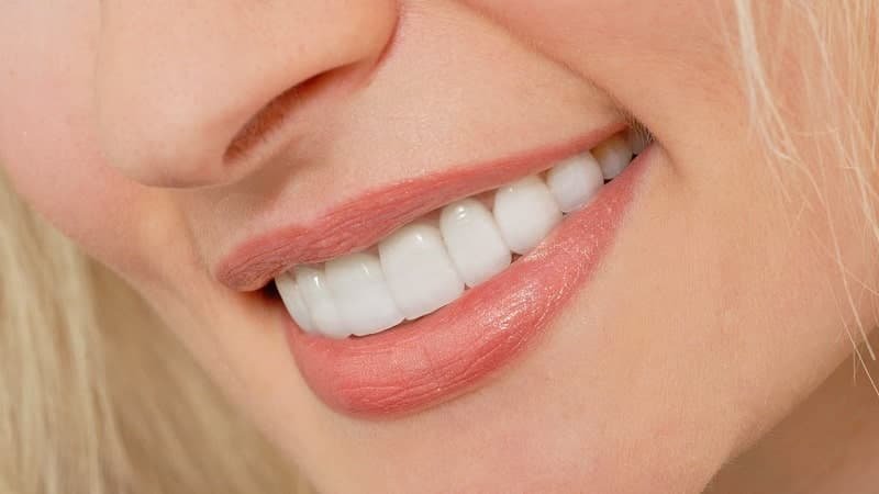 تجميل الاسنان بالفينيرز