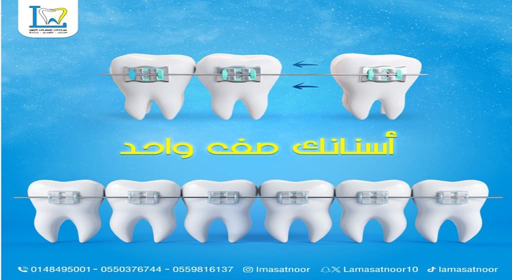 انواع عمليات تجميل الاسنان