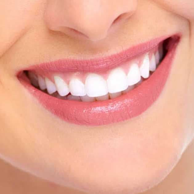 كيفية الحصول على ابتسامة هوليود