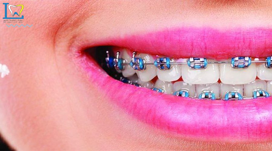 تقويم الاسنان التجميلي