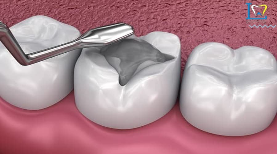 حشوة الاسنان التجميلية