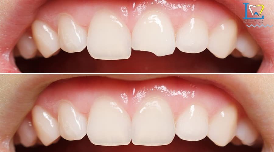 حشوة الاسنان التجميلية