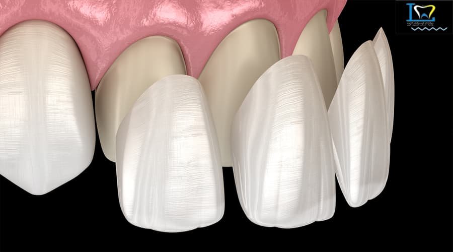 تجميل الاسنان بالفينيرز