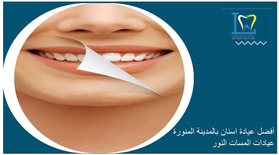 أفضل عيادة تبييض الأسنان بالليزر