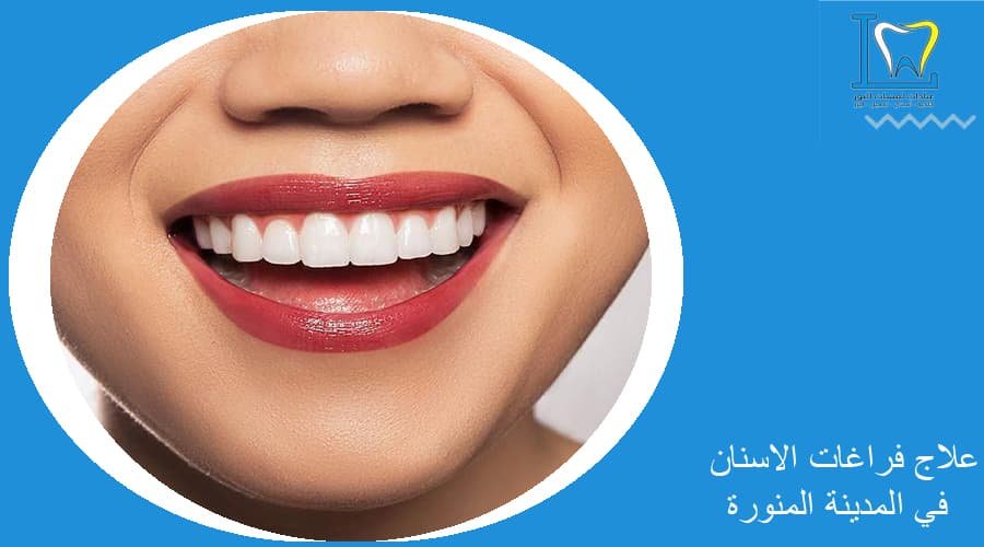 سد فراغات الأسنان بالتقويم