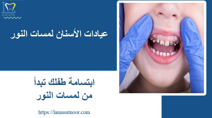 علاج تسوس اسنان الاطفال المدينة المنورة