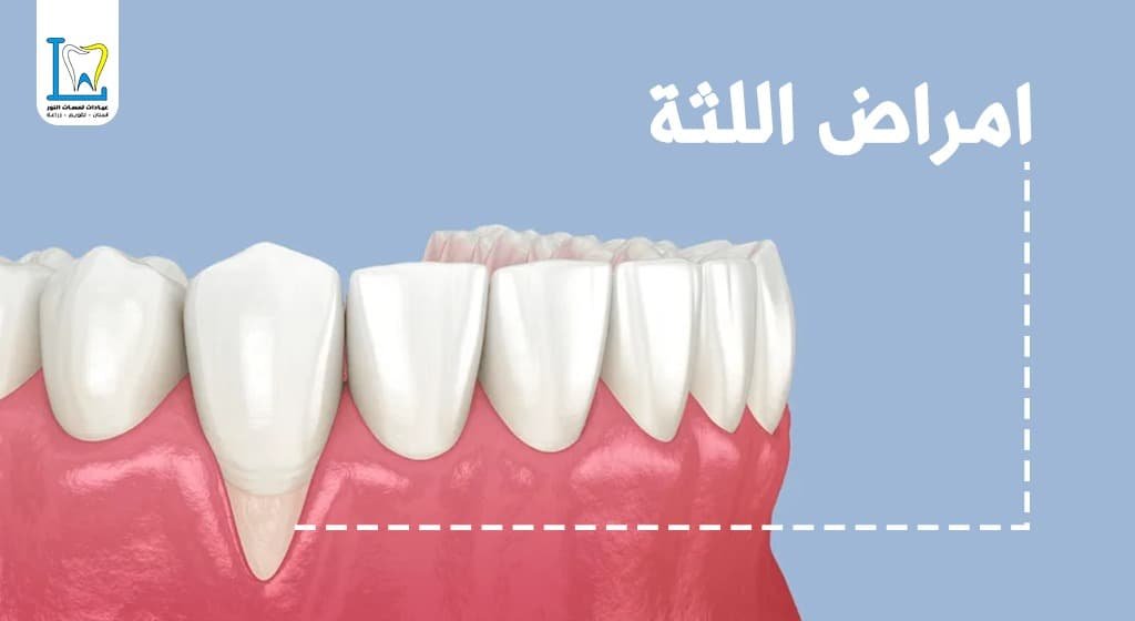 افضل دكتور لعلاج انحسار اللثة