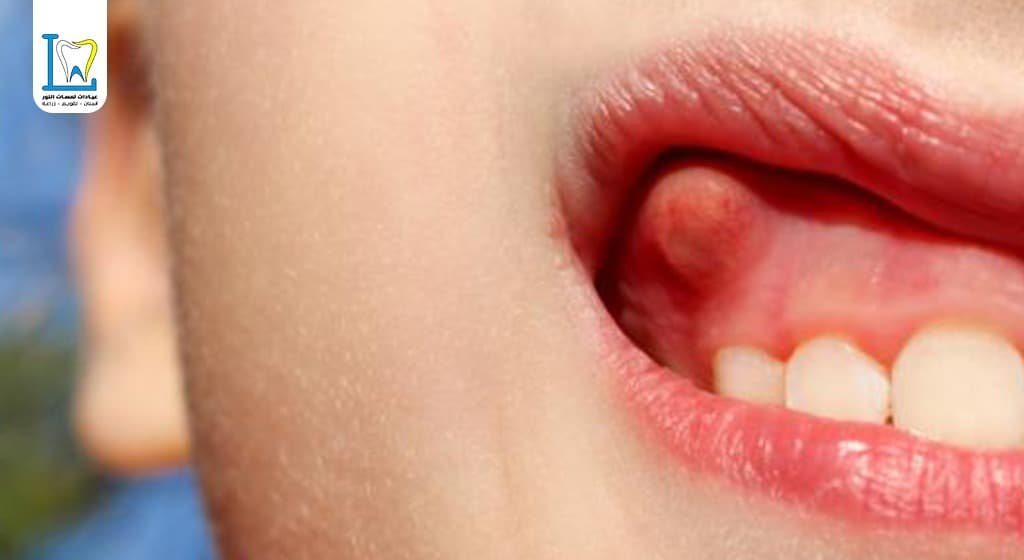 خراج اللثة عند الاطفال