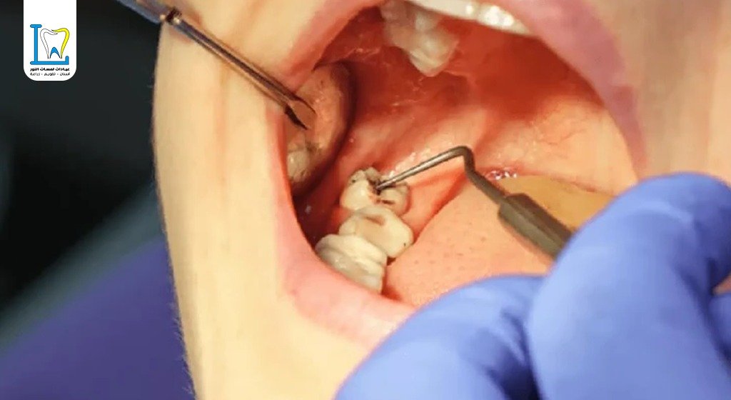 دكتور خلع ضرس العقل