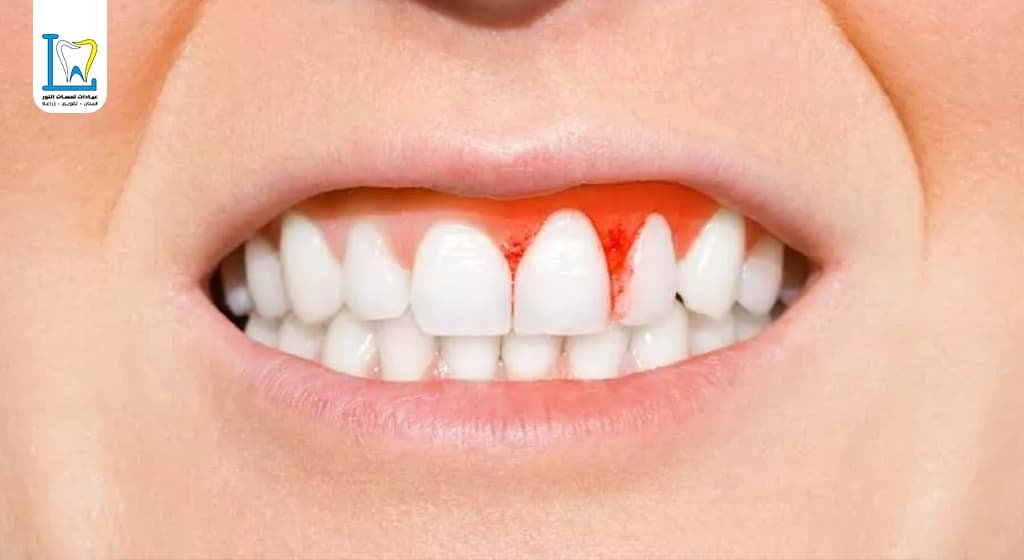 علاج امراض اللثة والاسنان