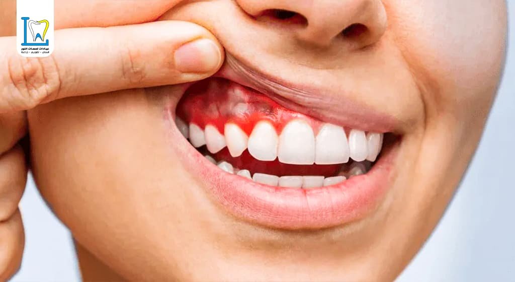 الفرق بين التهاب اللثة والتهاب العصب