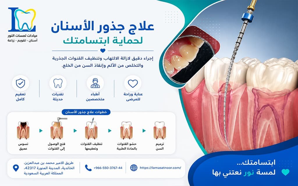 علاج تسوس جذور الاسنان