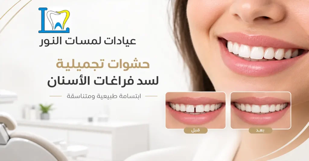حشوات تجميلية لسد فراغات الأسنان