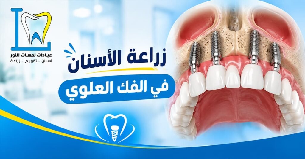 زراعة الأسنان في الفك العلوي بالمدينة المنورة